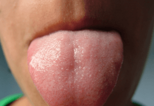 Healthy pink coating of tongue