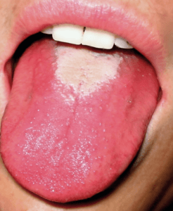 what-does-a-healthy-tongue-look-like-3-signs-to-look-for