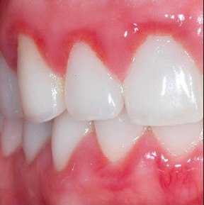 home-treatment-for-gum-disease-clinically-proven