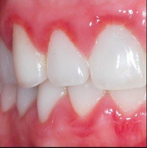Gum Disease and Treatment