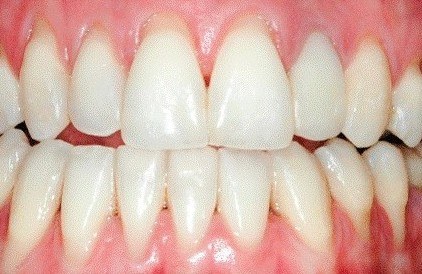 sensitive-teeth-remedies-3-best-options