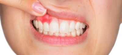 Inflammation of the gums