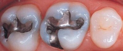 What Is In An Amalgam? (Truth and Controversy)