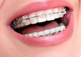 Best dental floss for braces